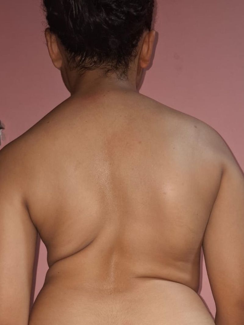 Antes — Escoliosis Toracolumbar